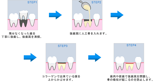 ソケットプリザベーション