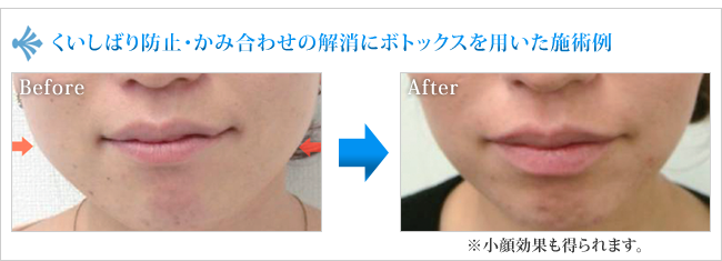 くいしばり防止・かみ合わせの解消にボトックスを用いた施術例
